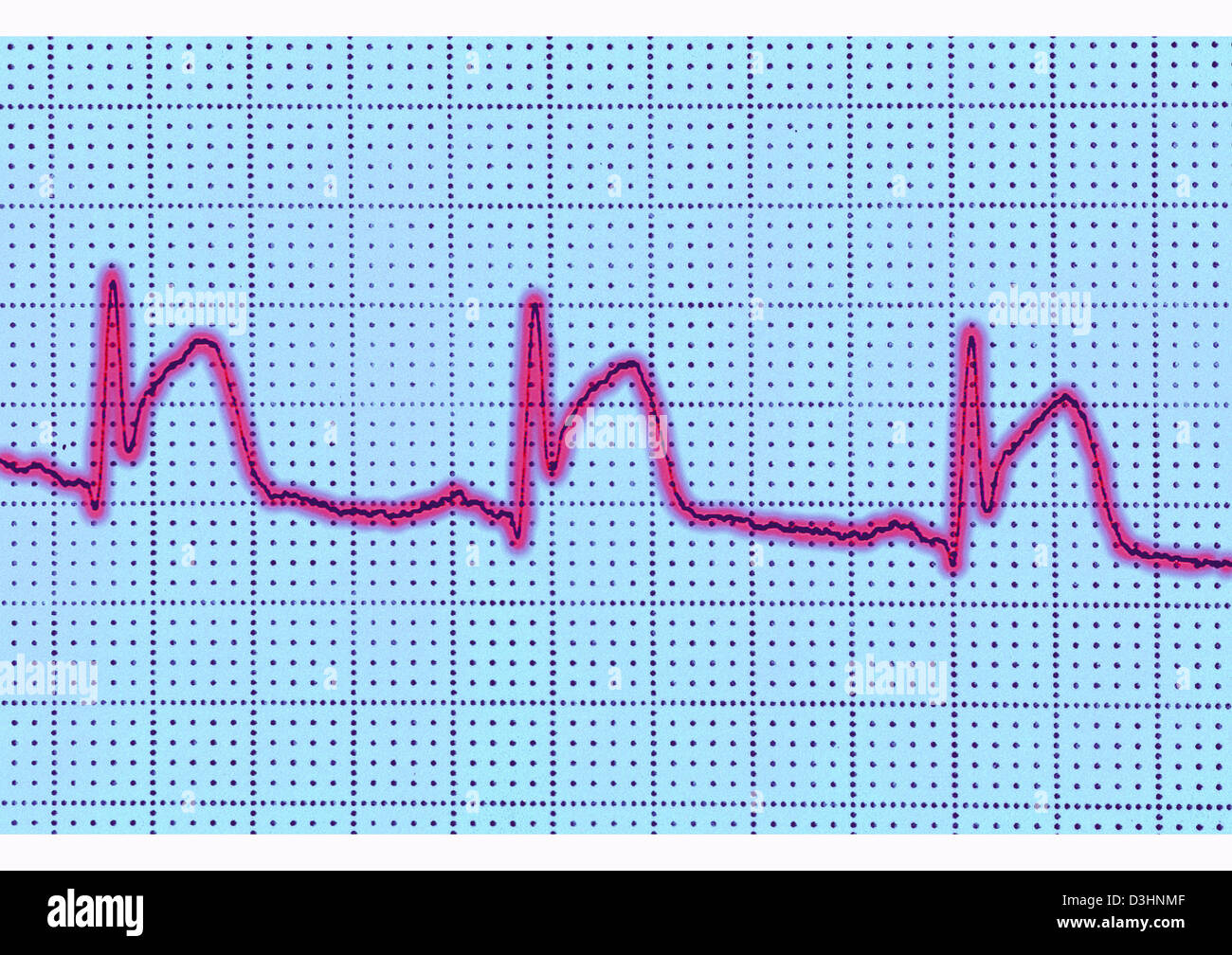 Heart attack ecg hi-res stock photography and images - Alamy