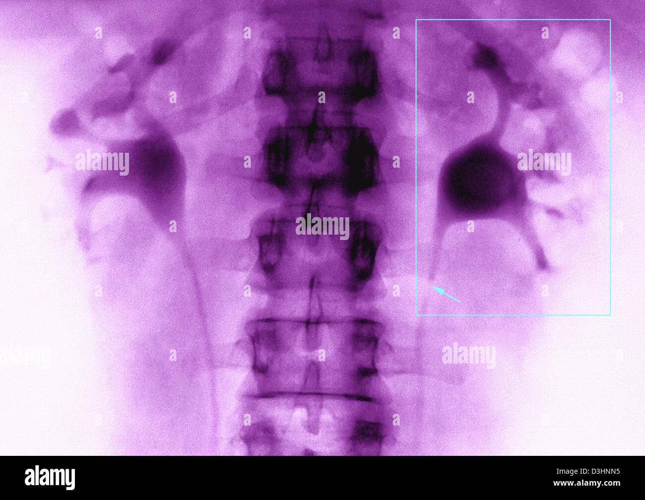 URETERAL LITHIASIS, X-RAY Stock Photo