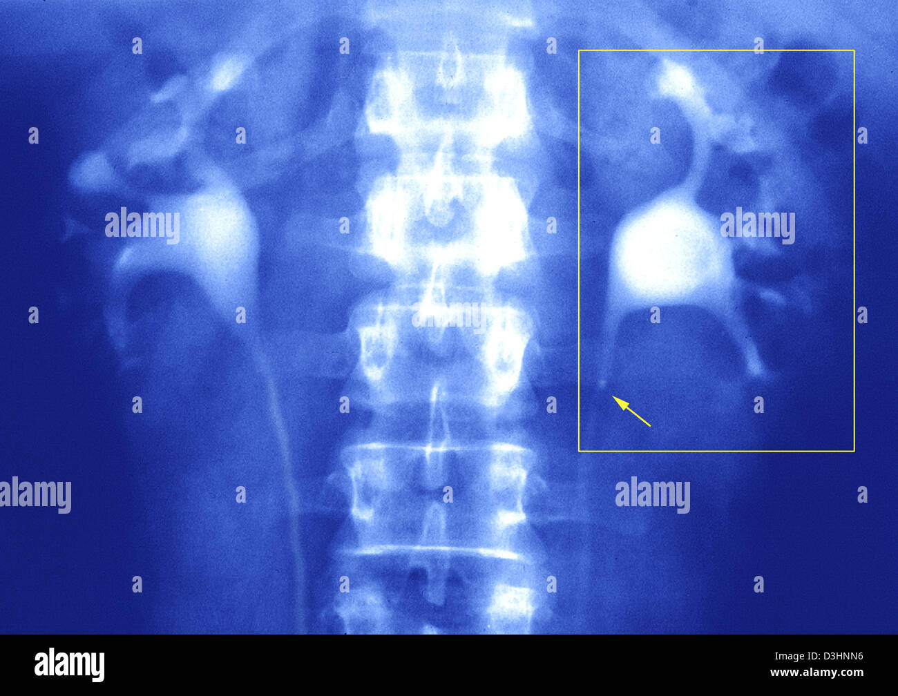 URETERAL LITHIASIS, X-RAY Stock Photo