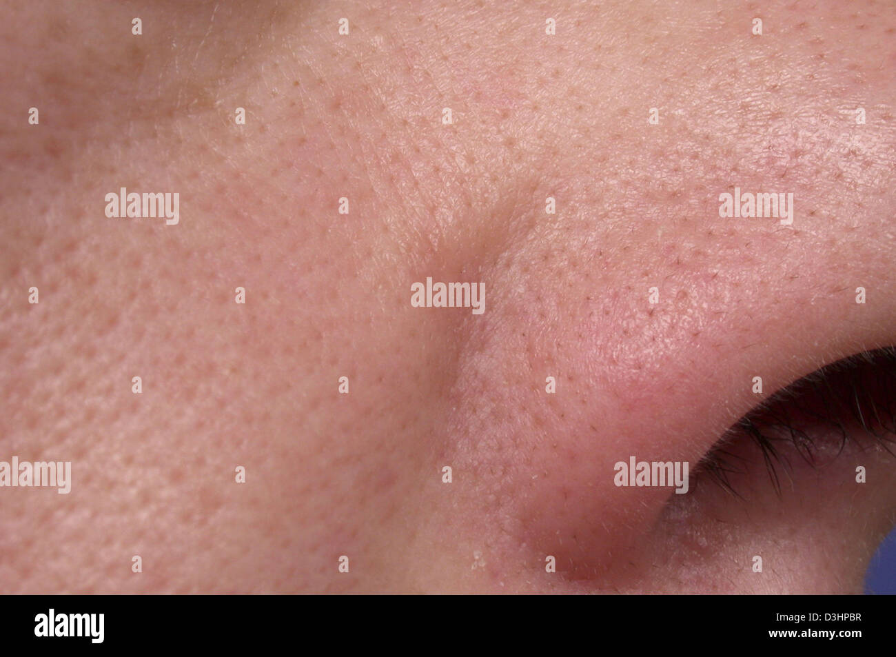 Chafed skin hi-res stock photography and images - Alamy