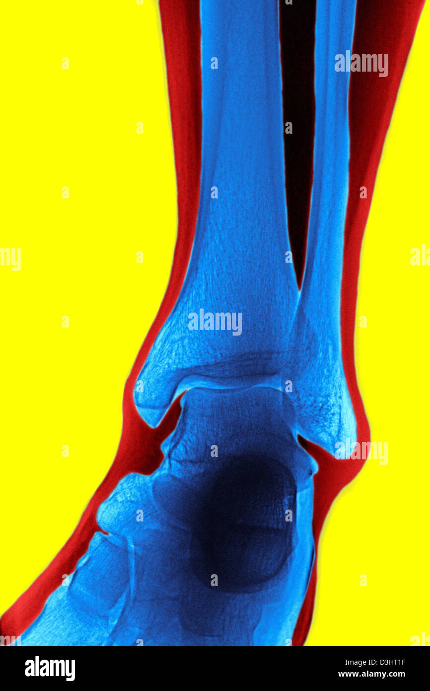 ANKLE, X-RAY Stock Photo