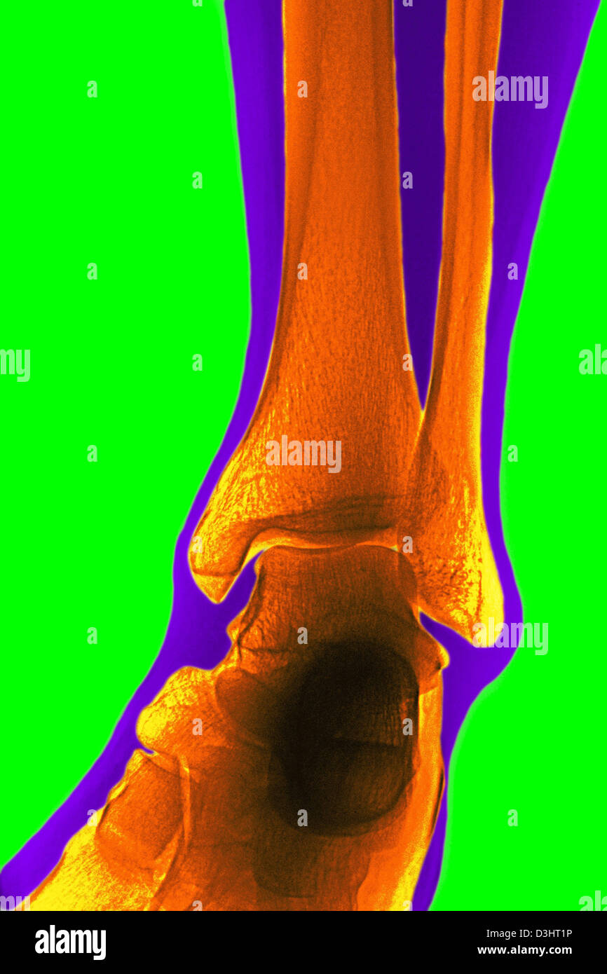 ANKLE, X-RAY Stock Photo