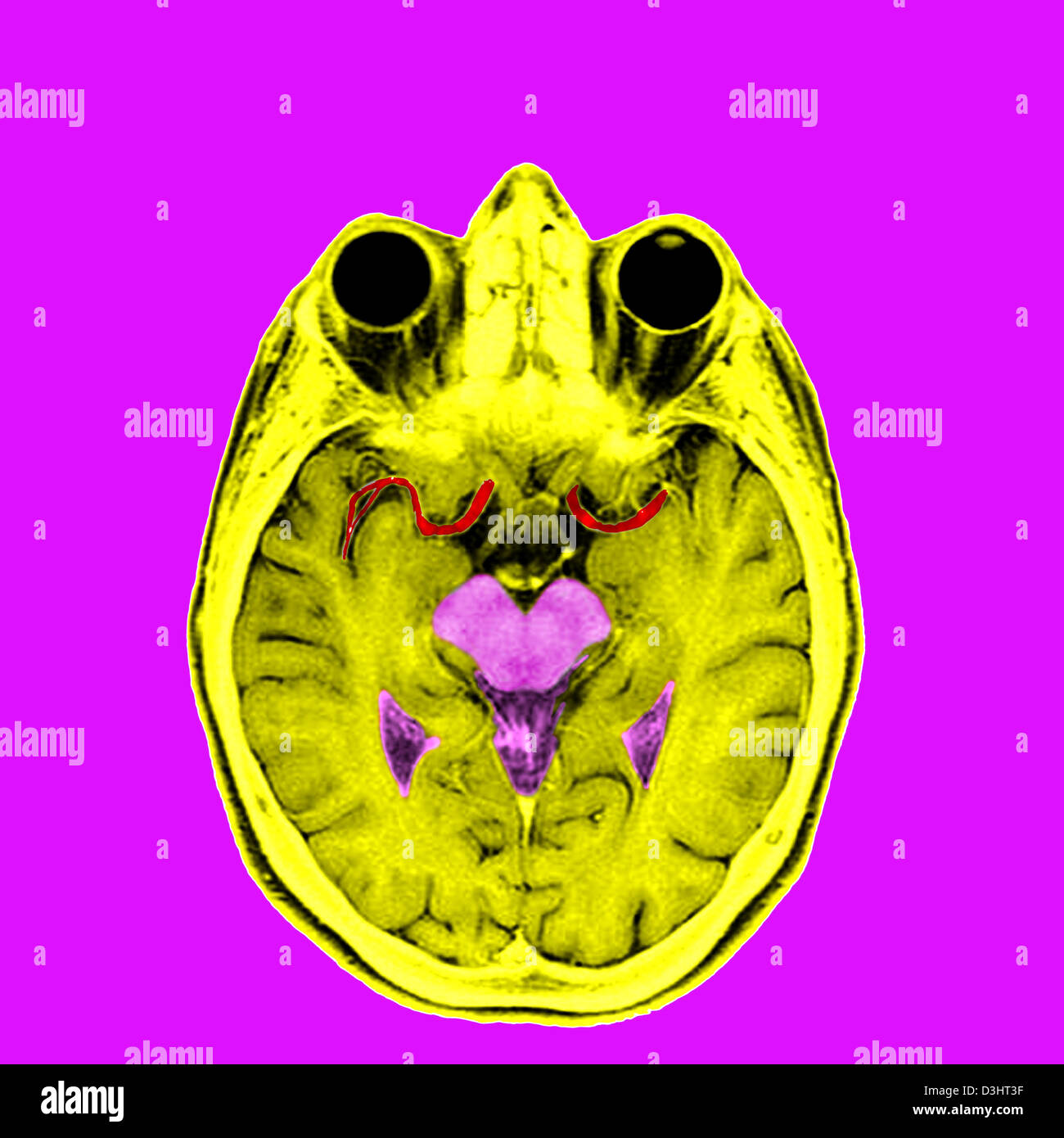 HEAD, MRI Stock Photo