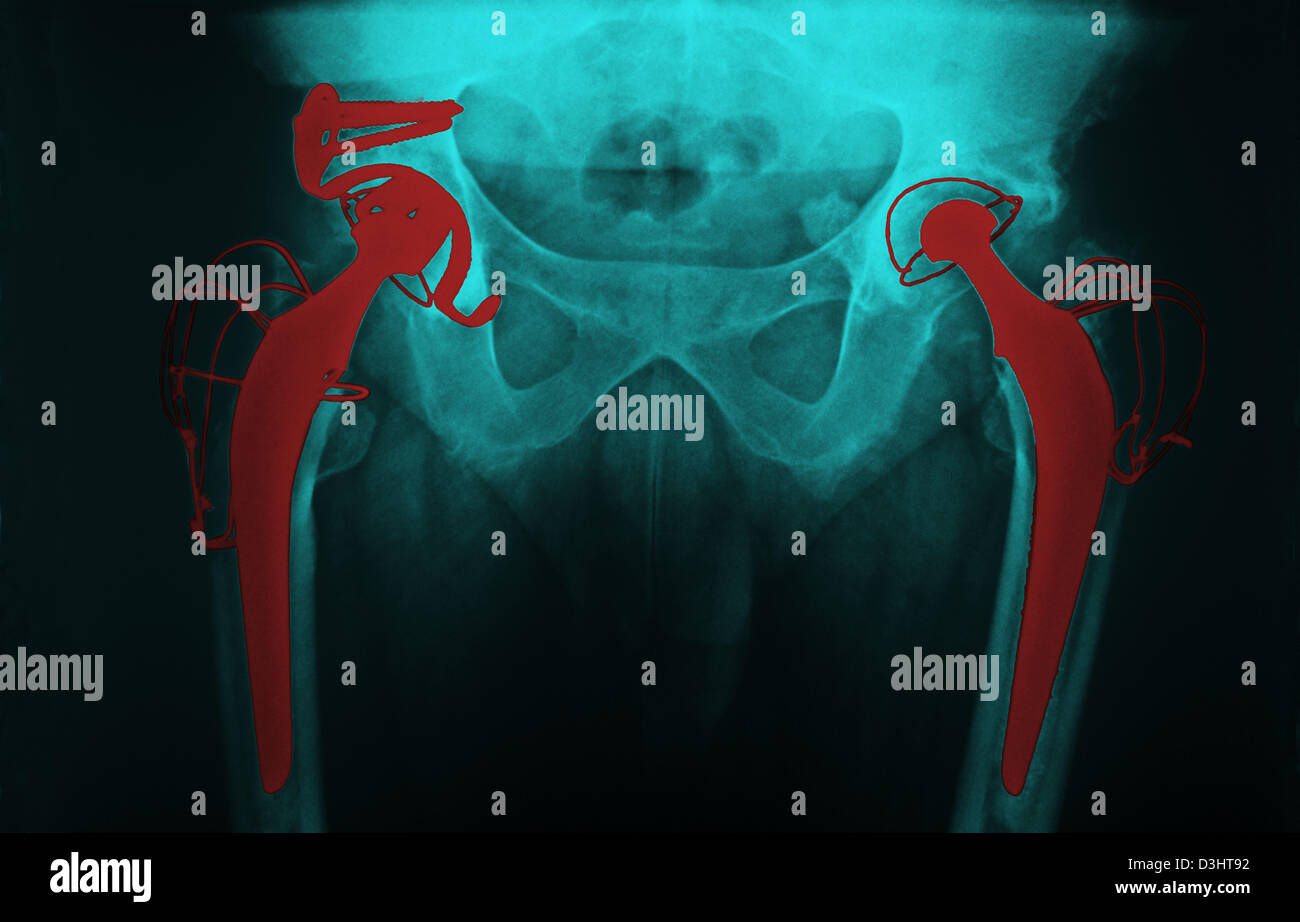 hip-prosthesis-x-ray-stock-photo-alamy