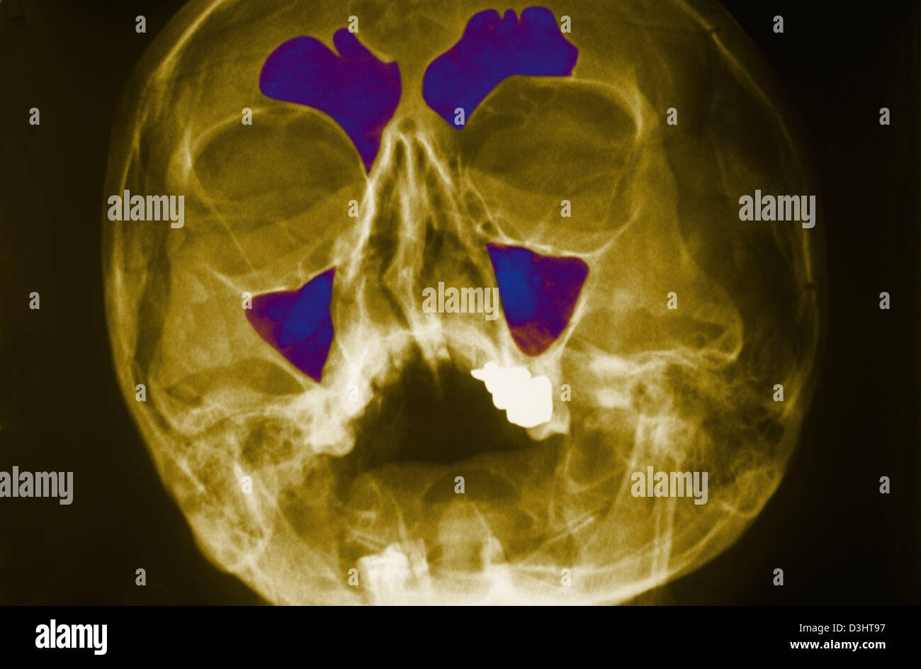 SINUS, XRAY Stock Photo Alamy