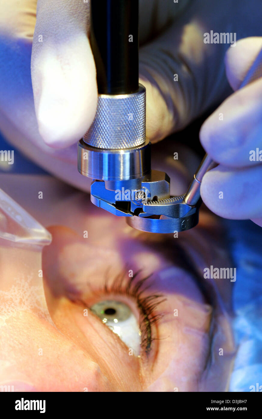 (dpa) - A precision plane is being positioned above the eye of a patient for a LASIK eye surgery at the Hohenzollernklinik - Centre for refractive surgery in Muenster, Germany, 27 January 2005. LASIK stands for 'Laser-Assisted In Situ Keratomileusis' and refers to a surgical procedure on the eye with an excimer laser intended to reduce a person's dependency on glasses or contact le Stock Photo