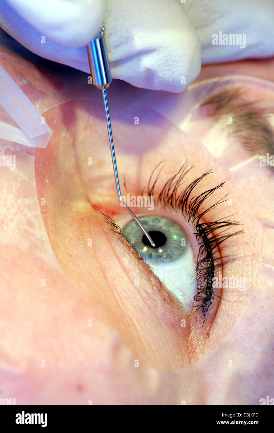 (dpa) - A LASIK spatula, to open the cornea, is being positioned  above the eye of a patient for a LASIK eye surgery at the Hohenzollernklinik - Centre for refractive surgery in Muenster, Germany, 27 January 2005. LASIK stands for 'Laser-Assisted In Situ Keratomileusis' and refers to a surgical procedure on the eye with an excimer laser intended to reduce a person's dependency on g Stock Photo