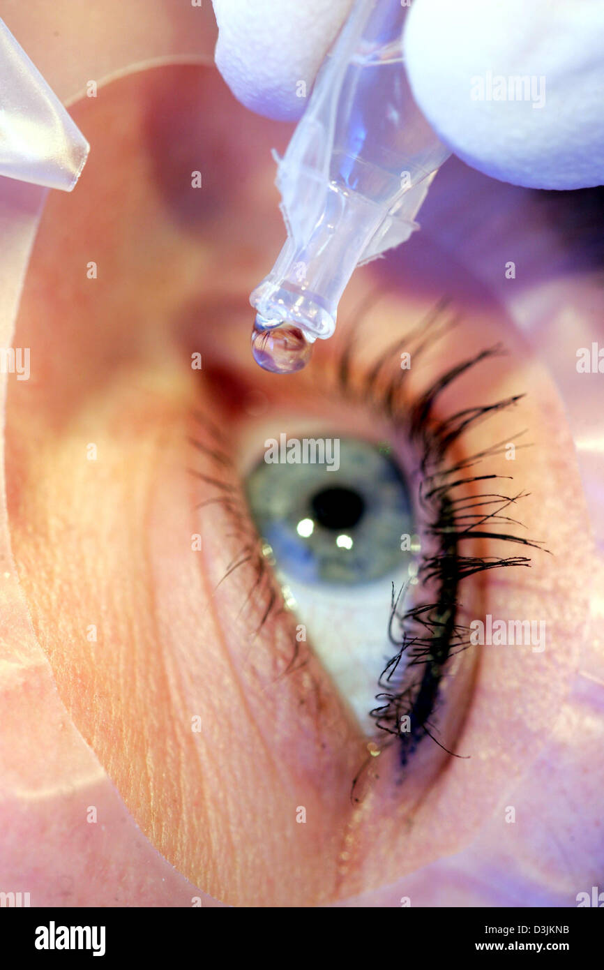 (dpa) - Eye drops are being dribbled onto the eye of a patient in preparation for a LASIK eye surgery at the Hohenzollernklinik - Centre for refractive surgery in Muenster, Germany, 27 January 2005. LASIK stands for 'Laser-Assisted In Situ Keratomileusis' and refers to a surgical procedure on the eye with an excimer laser intended to reduce a person's dependency on glasses or conta Stock Photo