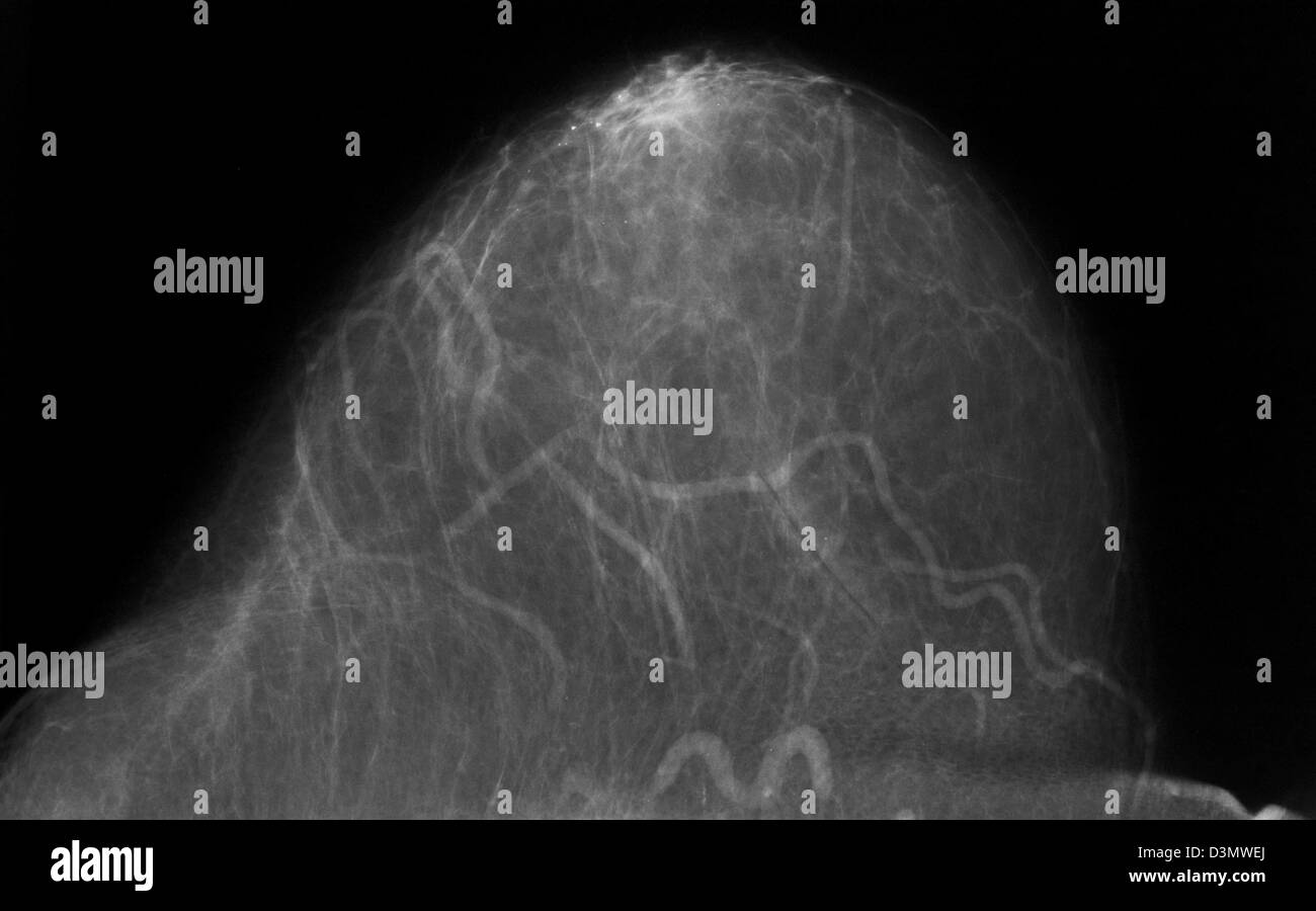 Mammogram shown benign calcifications Stock Photo