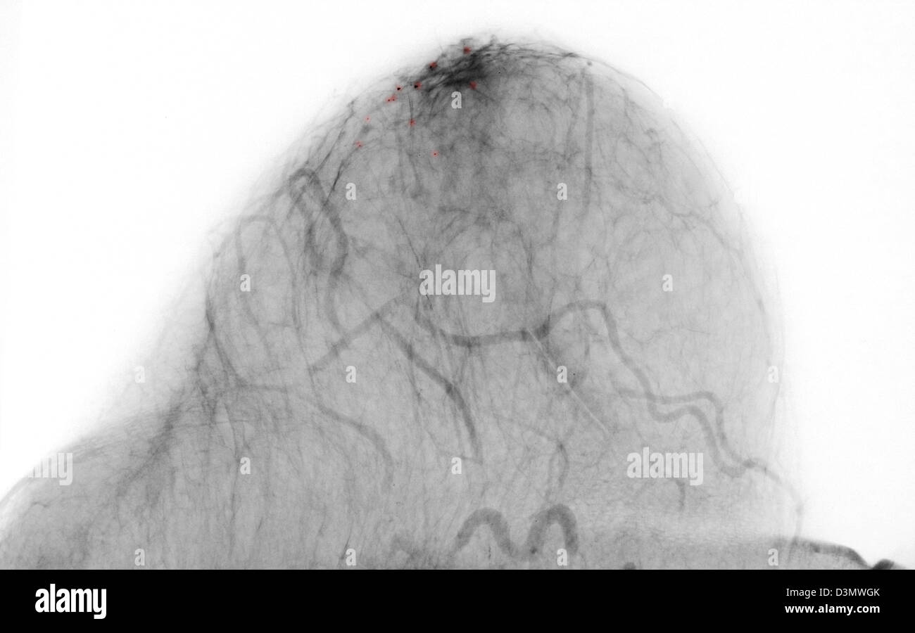 Mammogram shown benign calcifications Stock Photo