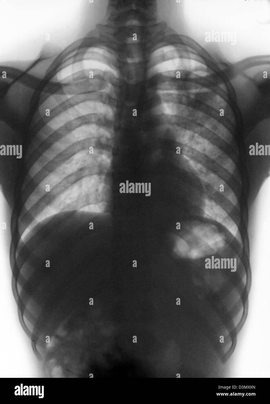 X-ray showing tuberculosis in a patient in Nigeria Stock Photo