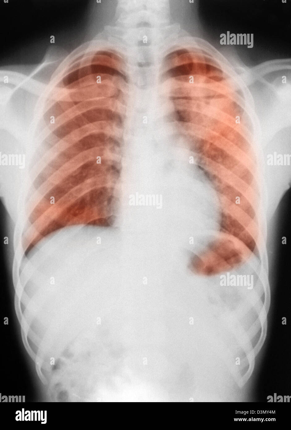 X-ray showing tuberculosis in a patient in Nigeria Stock Photo