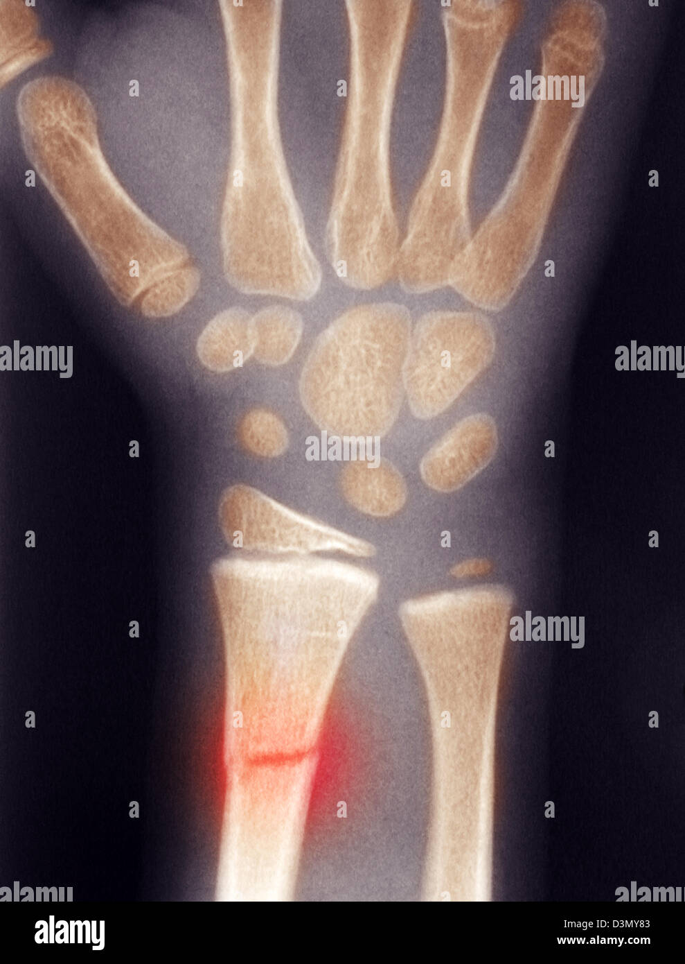 xray showing a distal radius fracture in a child Stock Photo Alamy