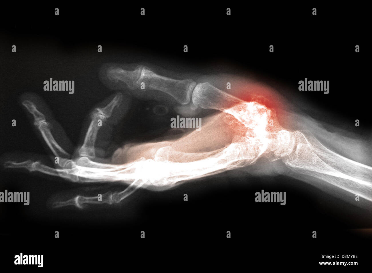 Hand x-ray of an older man showing degenerative arthritic disease at the base of the thumb metacarpal Stock Photo