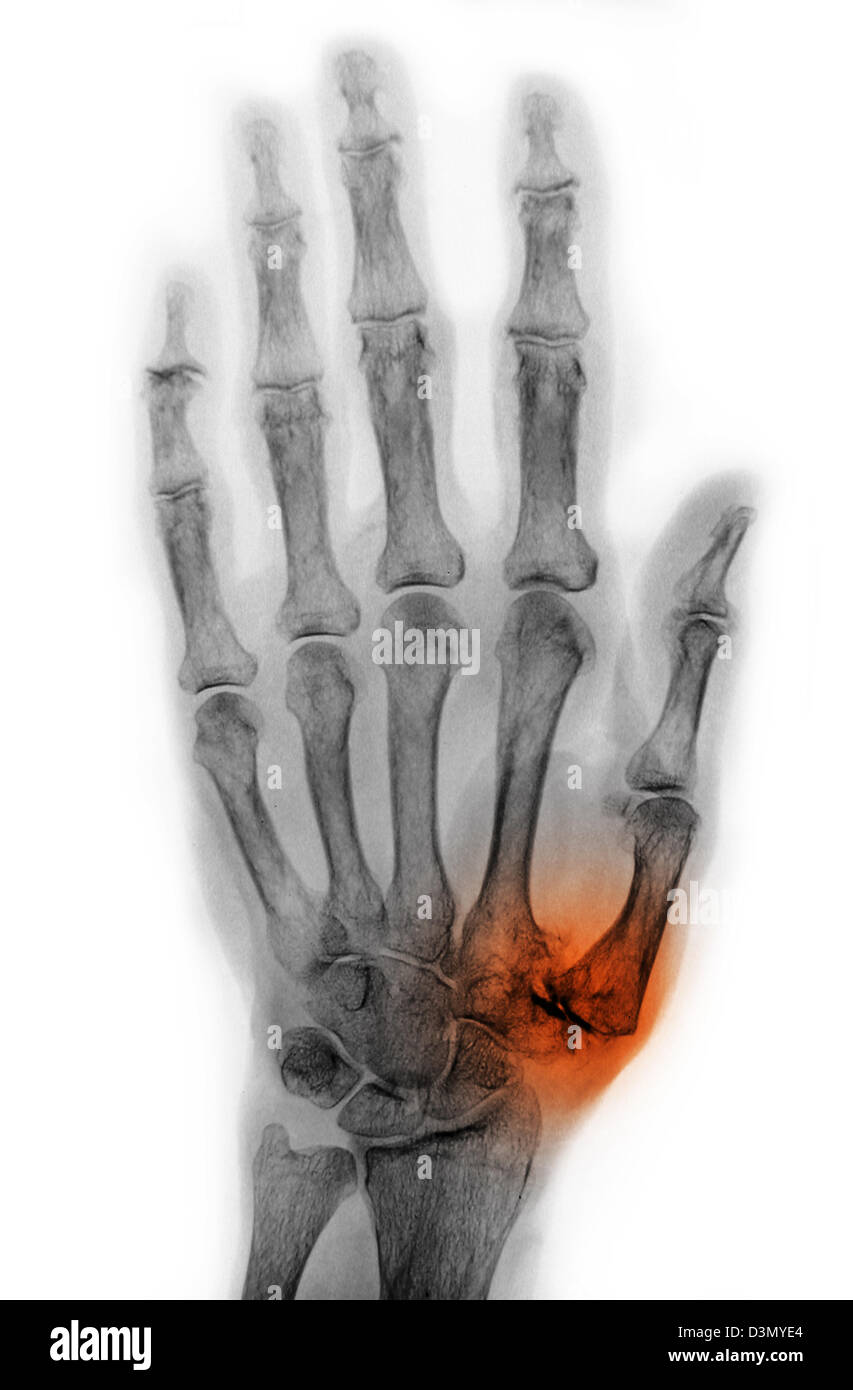 Hand X-ray Of An Older Man Showing Degenerative Arthritic Disease At 