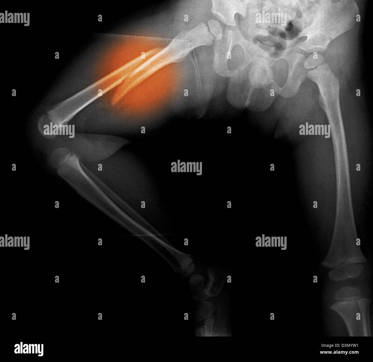 xray showing a femur fracture in a 3 year old boy, a victim of child