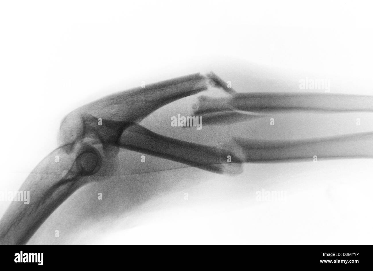 x-ray showing a severely angulated and comminuted fracture of the  forearm Stock Photo