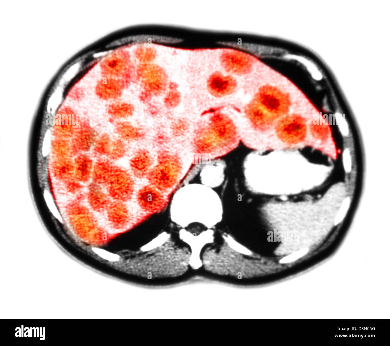 Liver Cancer Ct High Resolution Stock Photography and Images - Alamy