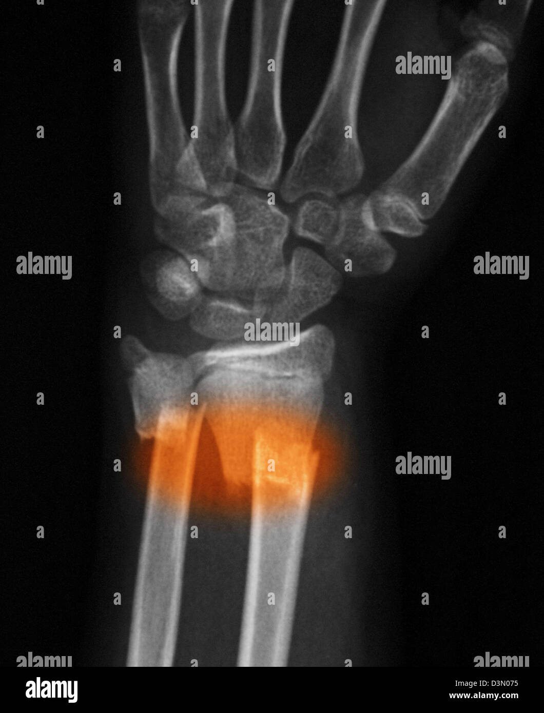 xray showing a distal radius and ulna fracture in a 12 year old girl