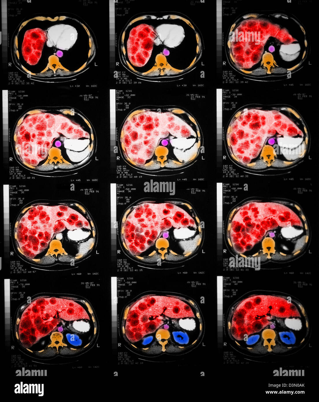 CT scan slices showing extensive metastatic liver cancer Stock Photo