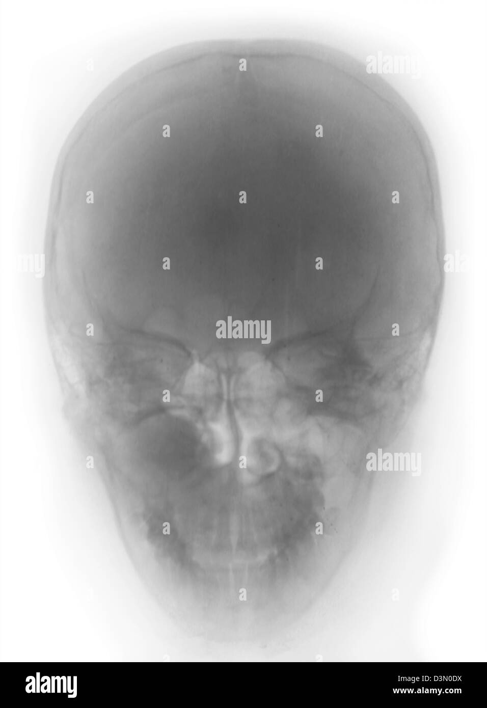 X-ray showing a maxillary sinus tumor Stock Photo