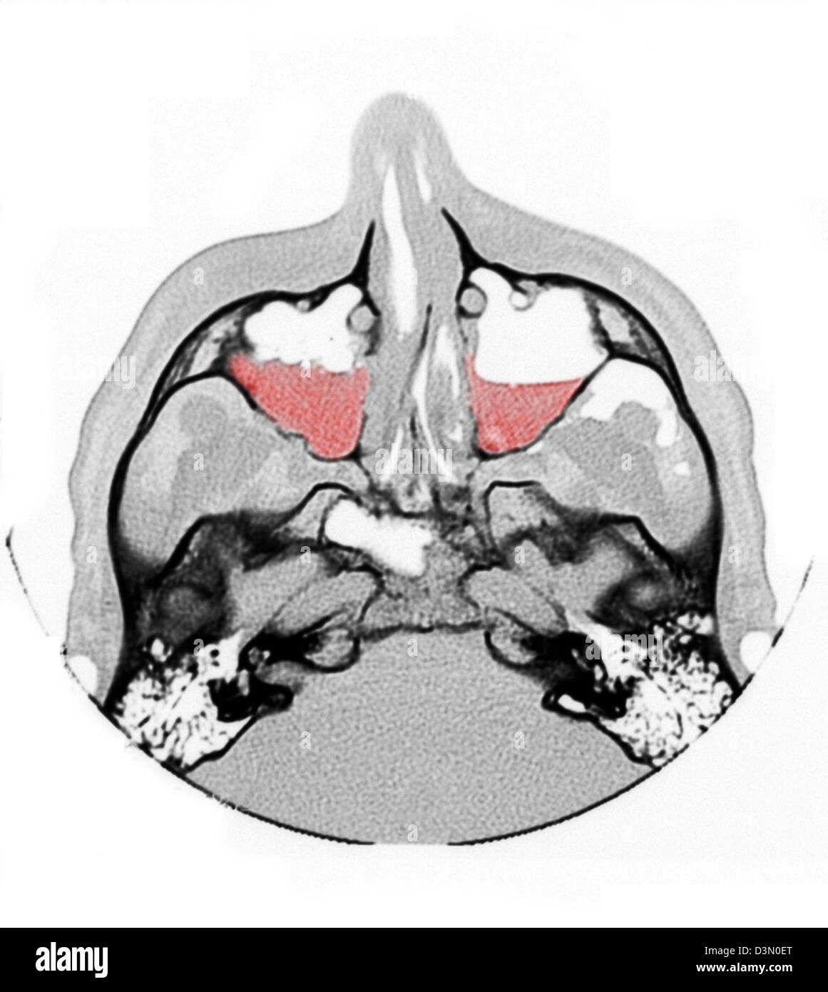 CT scan image showing bilateral maxillary sinus fractures Stock Photo