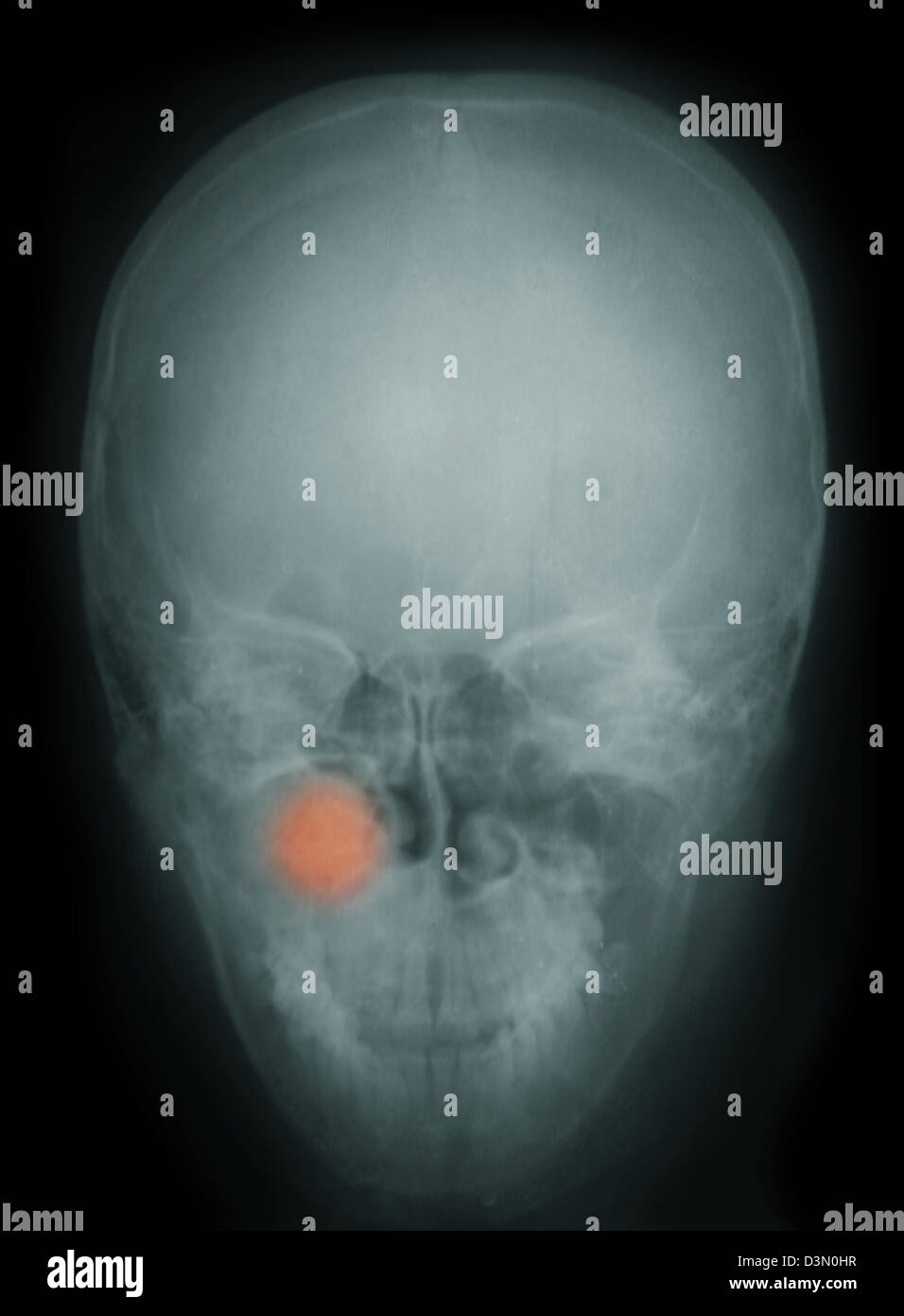 X-ray showing a maxillary sinus tumor Stock Photo