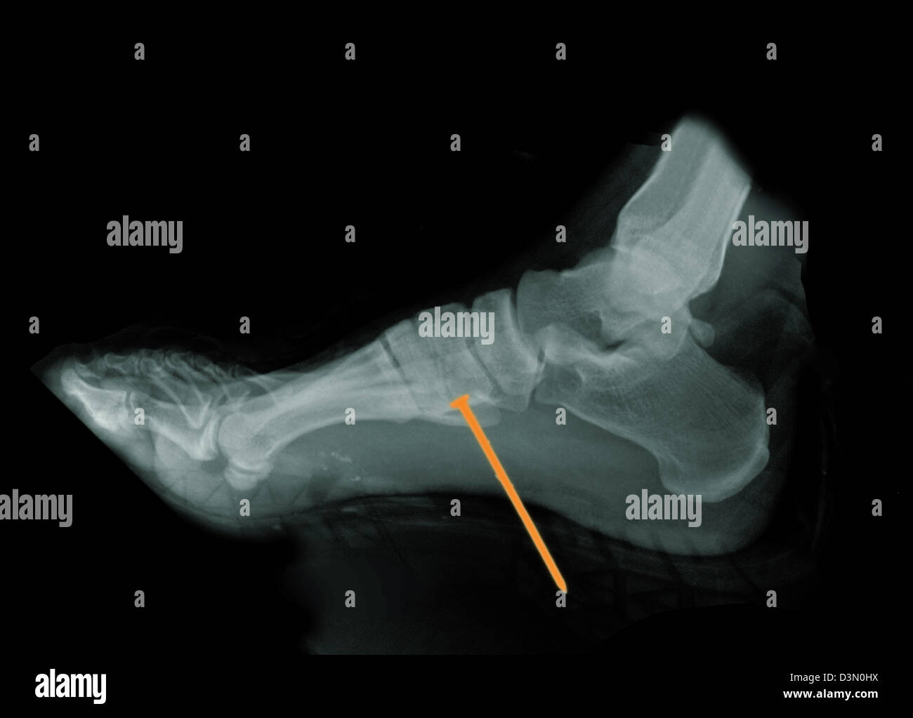 Foot x-ray of a 22 year old man who accidentally shot a nail from a nail gun through his boot and into his foot Stock Photo