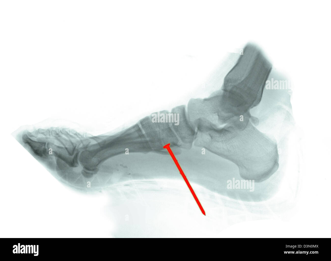 Foot x-ray of a 22 year old man who accidentally shot a nail from a nail gun through his boot and into his foot Stock Photo