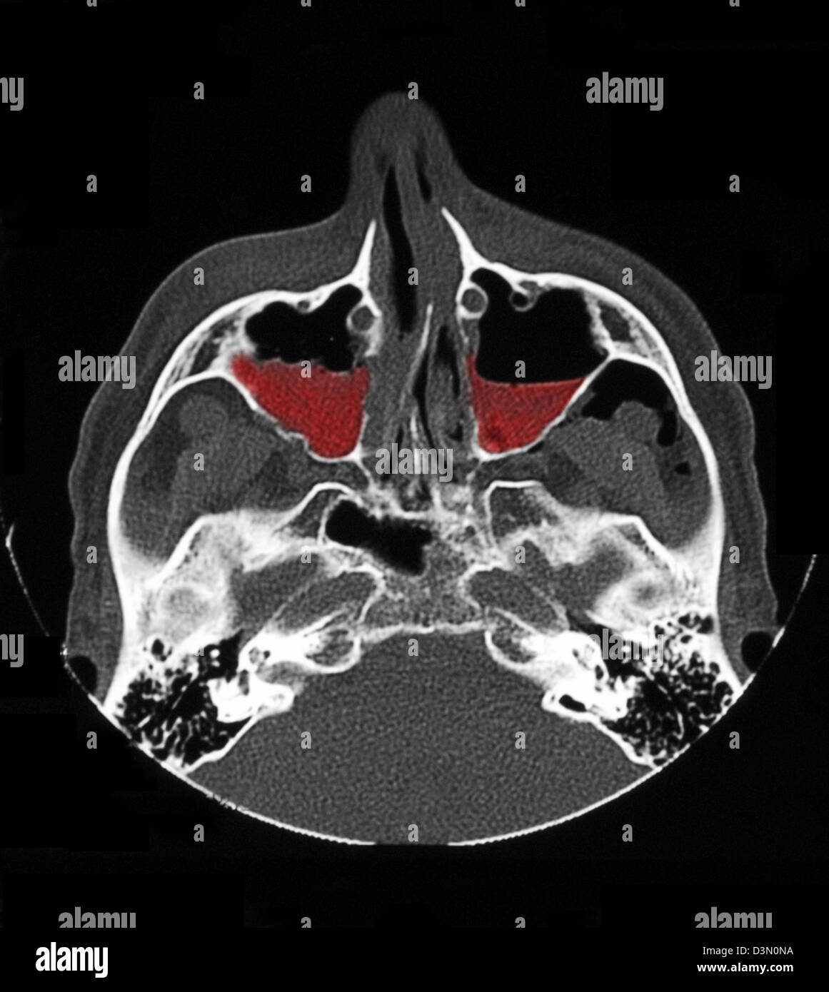 CT scan image showing bilateral maxillary sinus fractures Stock Photo