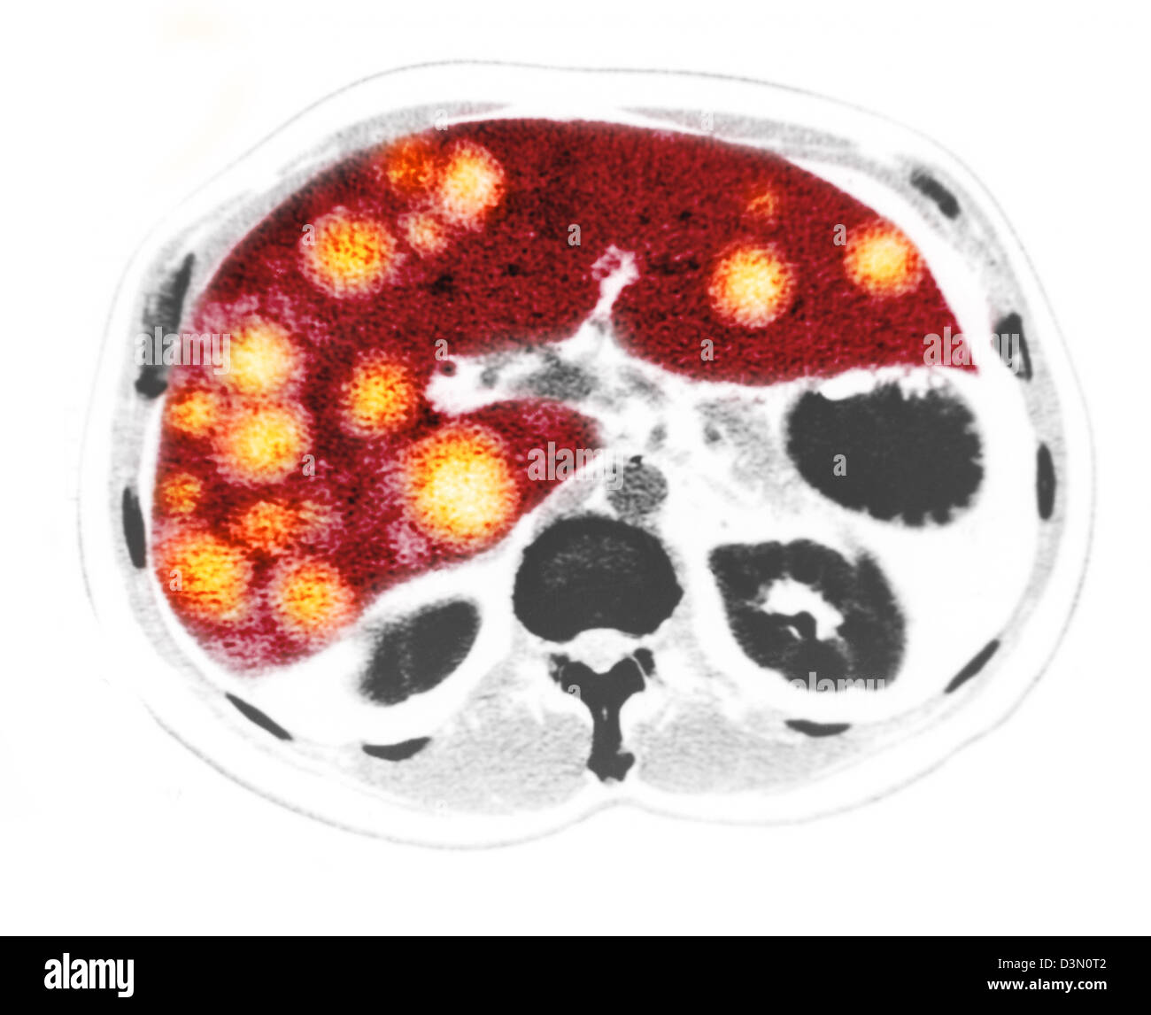 Ct Scan Slices Showing Extensive Metastatic Liver Cancer Stock Photo