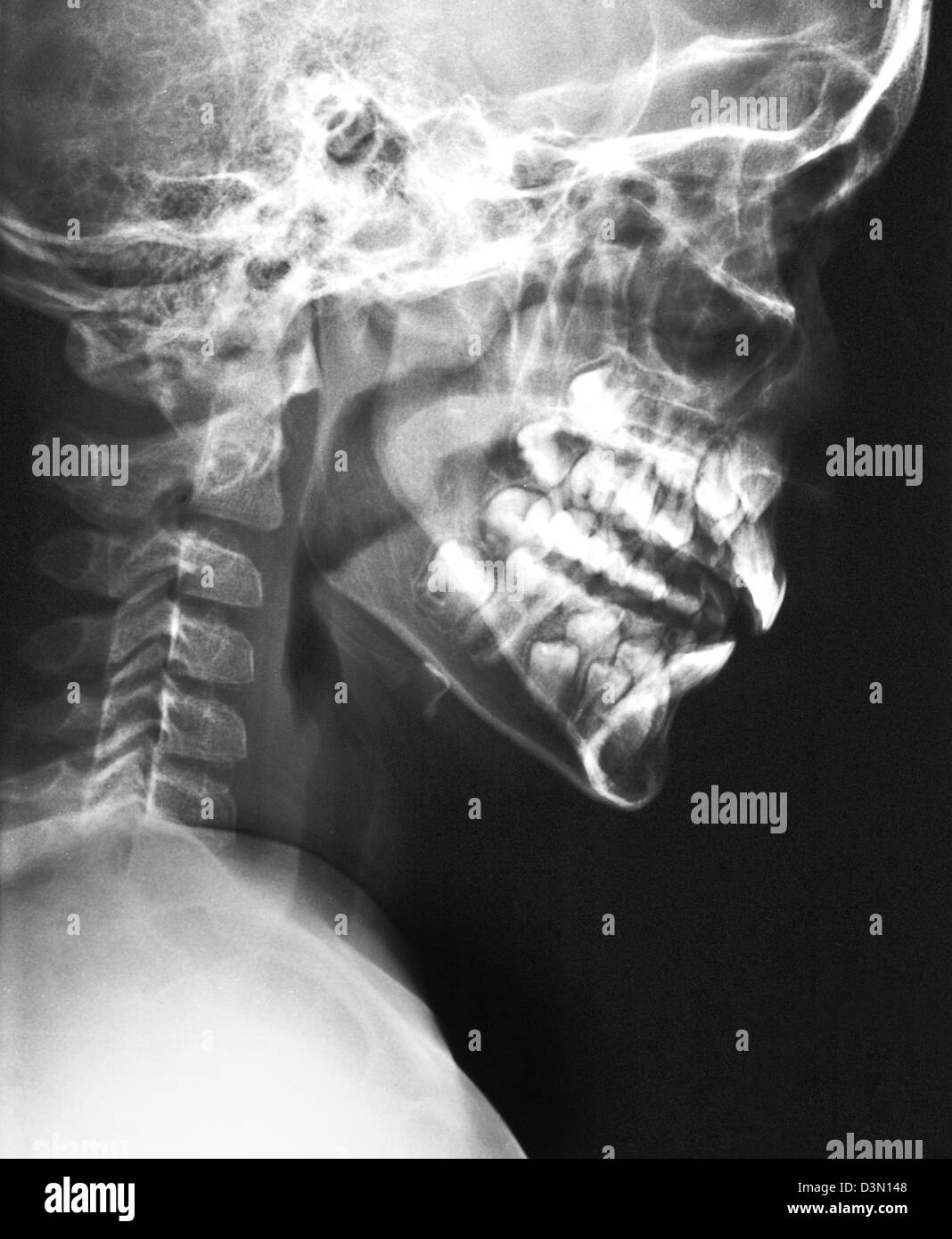 Skull X Ray Anatomy