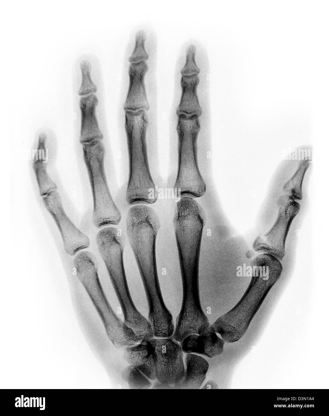 x-ray showing an avulsion fracture of the proximal phalanx of the thumb Stock Photo
