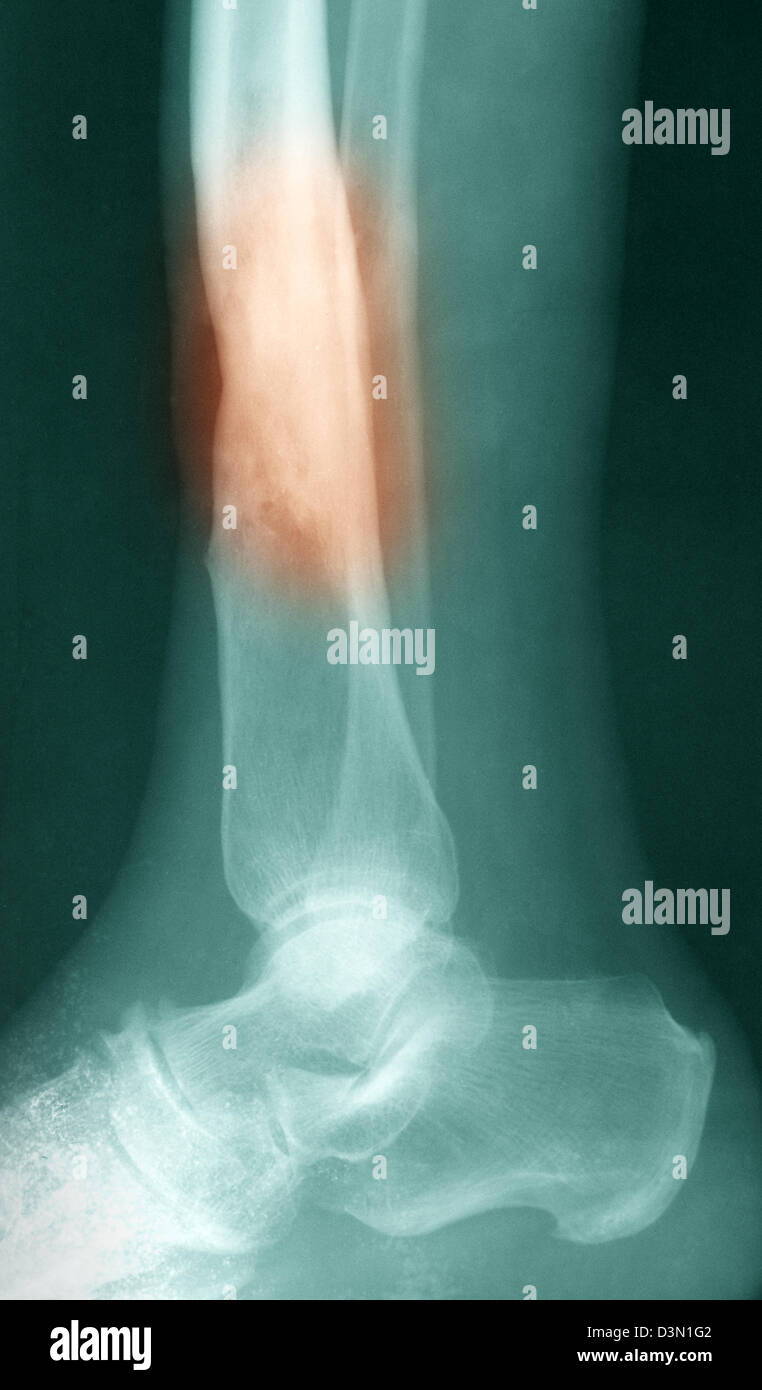 osteomyelitis in the lower back