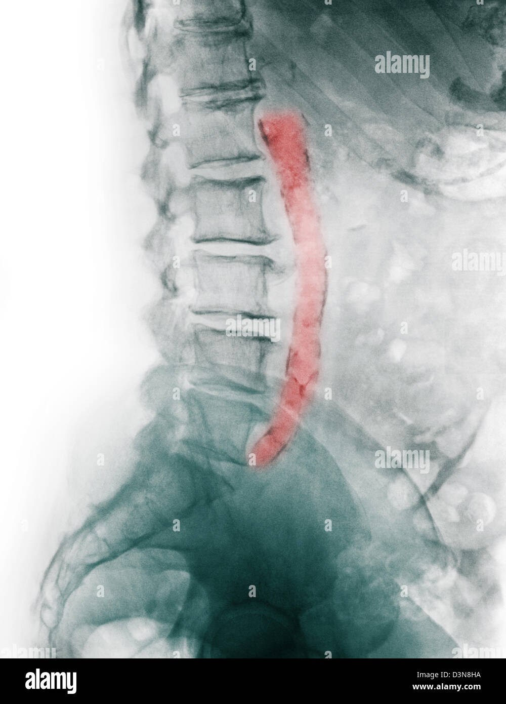 x-ray of an 81 year old woman showing a calcified aorta from atherosclerotic artery disease Stock Photo