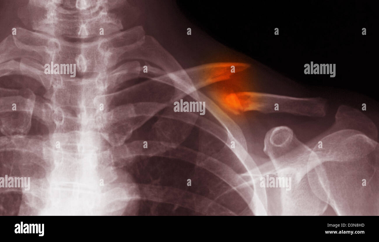 xray of the shoulder showing a clavicle fracture Stock Photo Alamy