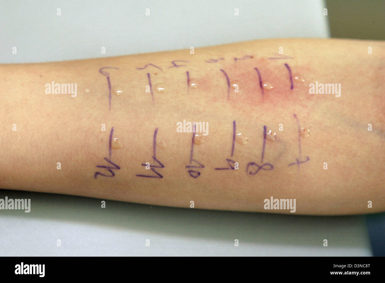 The picture shows an allergy test (Prick test) on the forearm of a ten
