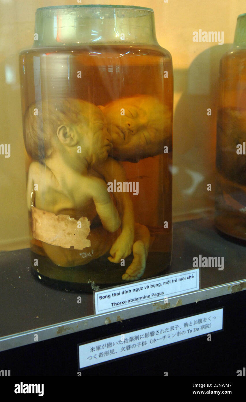 Conserved And Malformed Foetuses Exhibited At The War Remnants Museum In Saigon Vietnam Monday 27 February 06 Agent Orange Used By The U S Military For The Purpose Of Destroying Plants Which