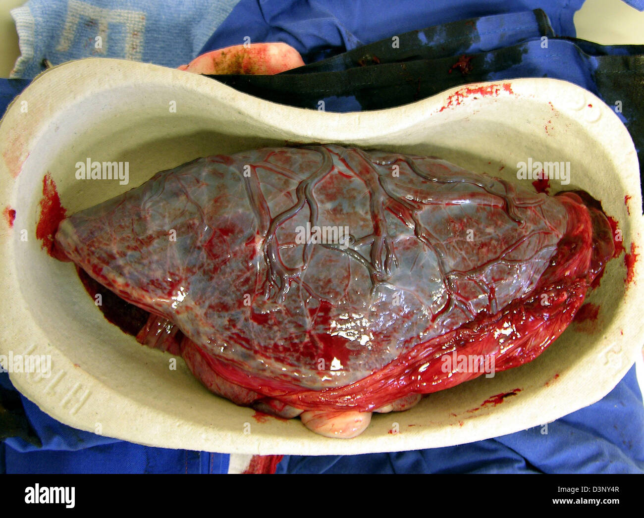 The afterbirth, placenta, photographed in a kidney dish at a hospital in Esslingen, Germany, 11 May 2004. Photo: Juergen Effner Stock Photo