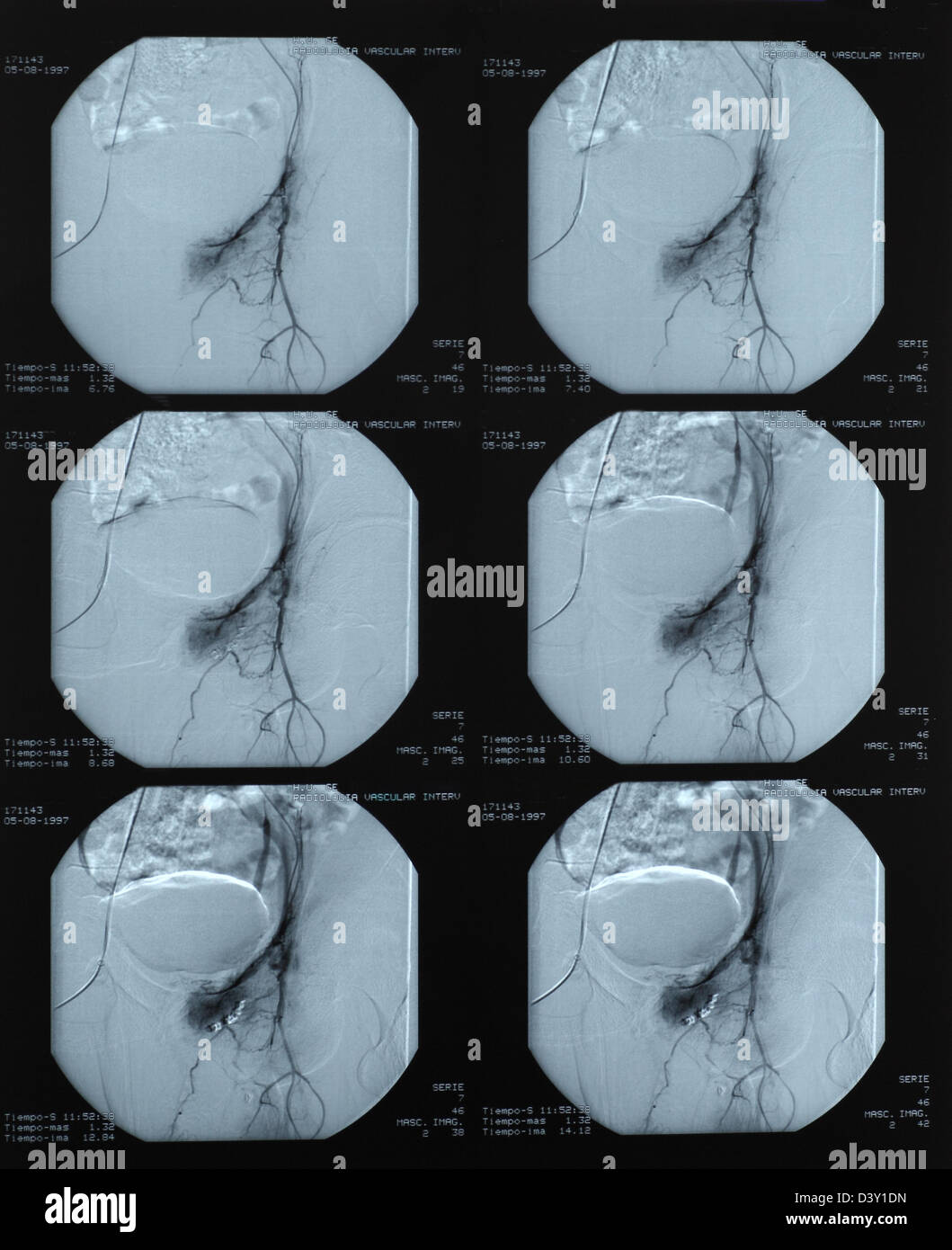 Vascular radiography of a blood leakage being operated Stock Photo