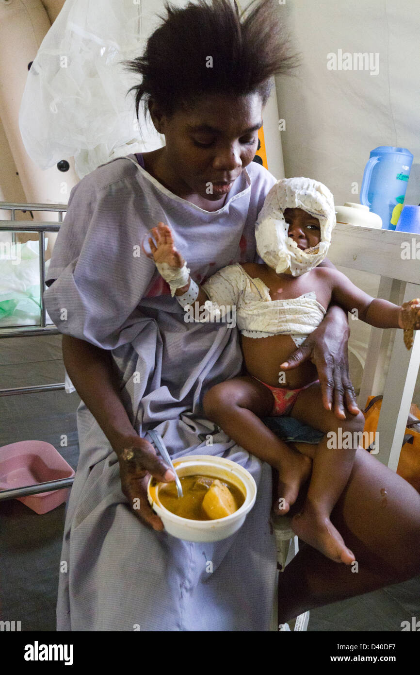 burn unit in Drouillard Hospital MSF PortauPrince Haiti Stock Photo Alamy