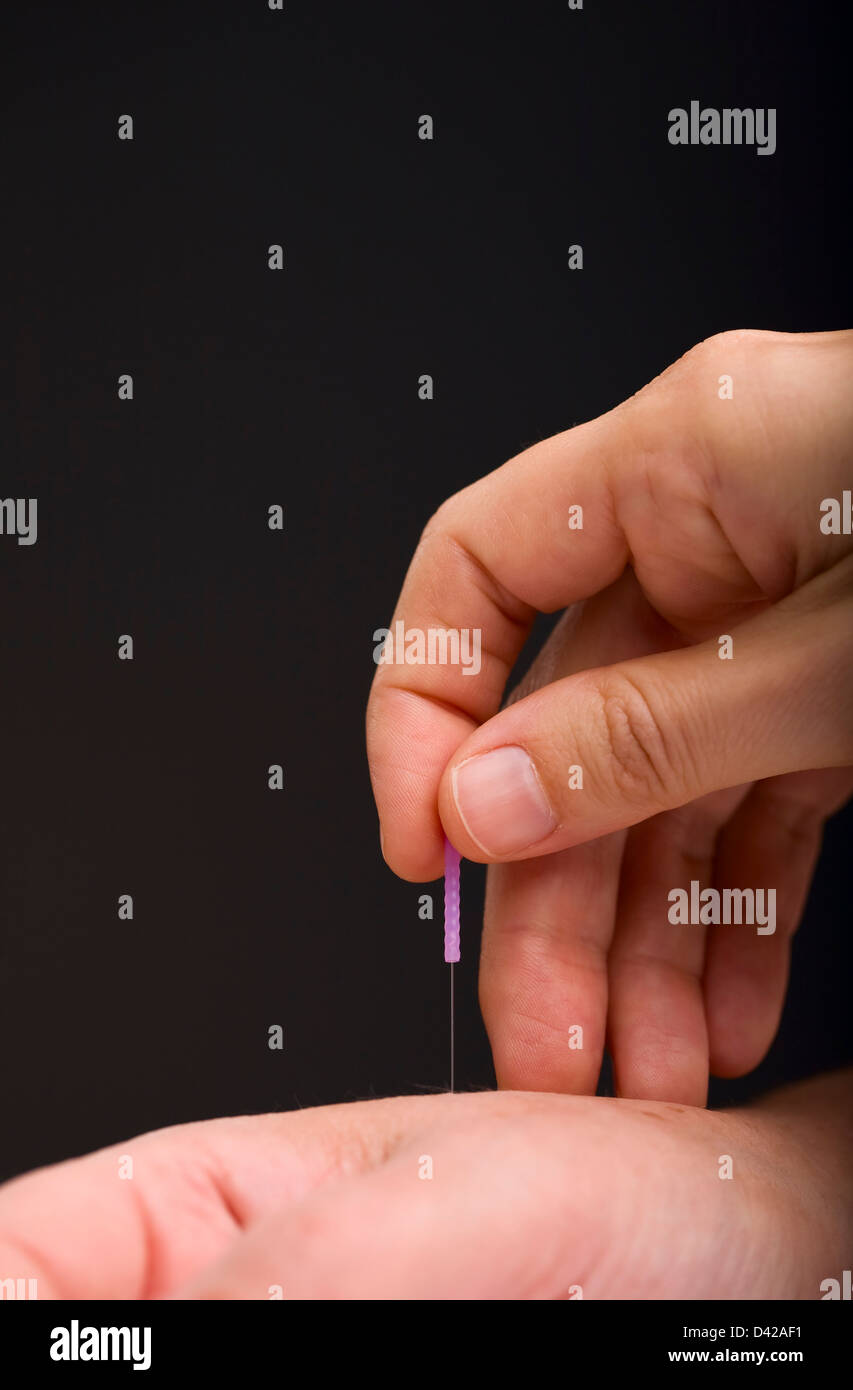 Acupuncturist applying needle to patients hand Stock Photo Alamy