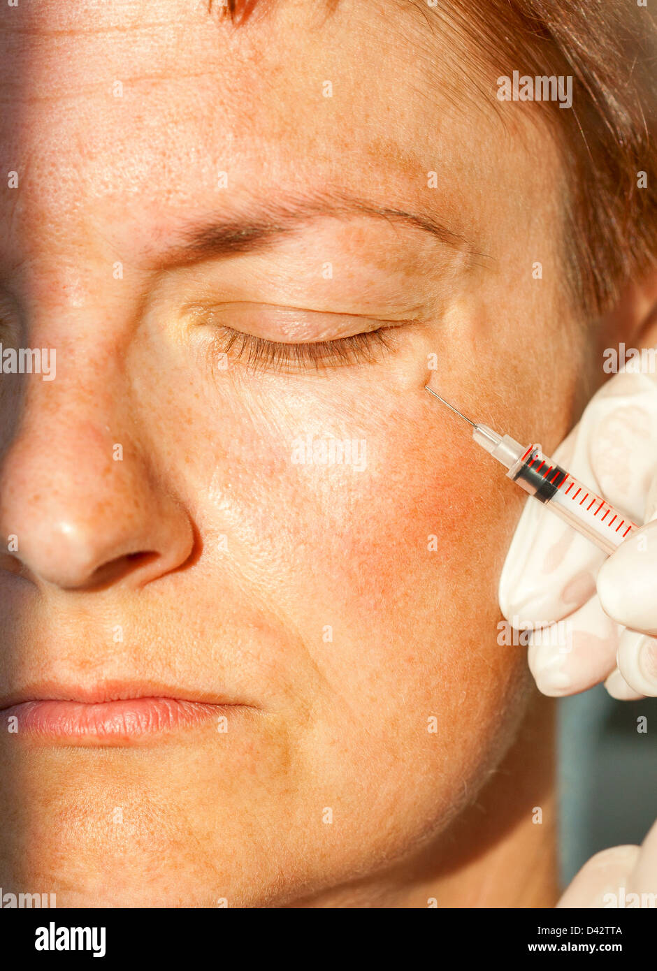 Botox syringe injection, close up Stock Photo Alamy