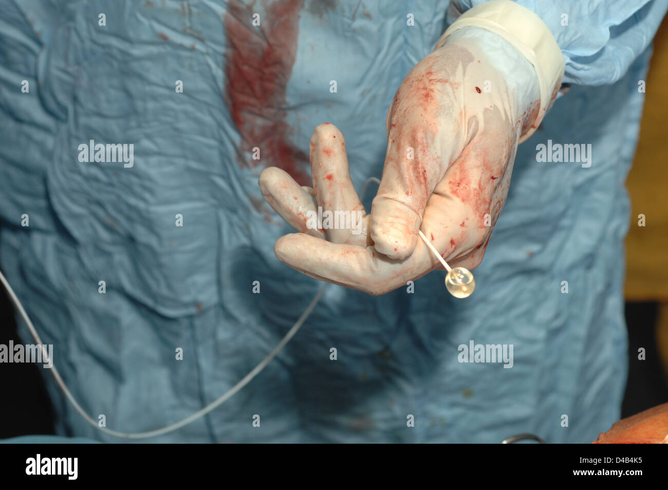A surgeon holding catheter inflatable balloon attached tip used perform embolectomy embolectomy performed check that femoral Stock Photo
