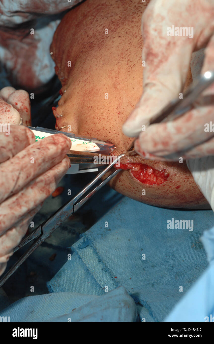 Surgical staples are used to close the wound, following the amputation of a right leg. Stock Photo