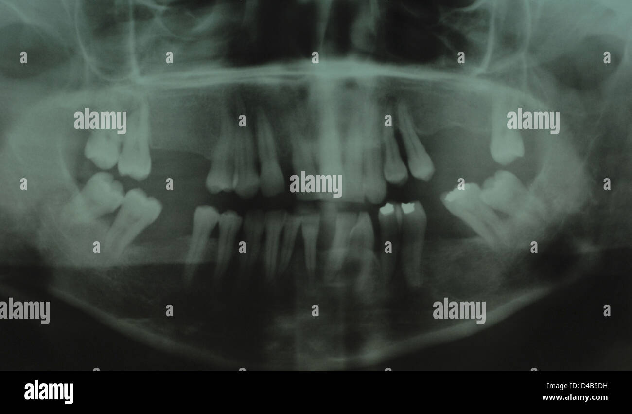 Black and white xray of teeth of young adult Stock Photo Alamy