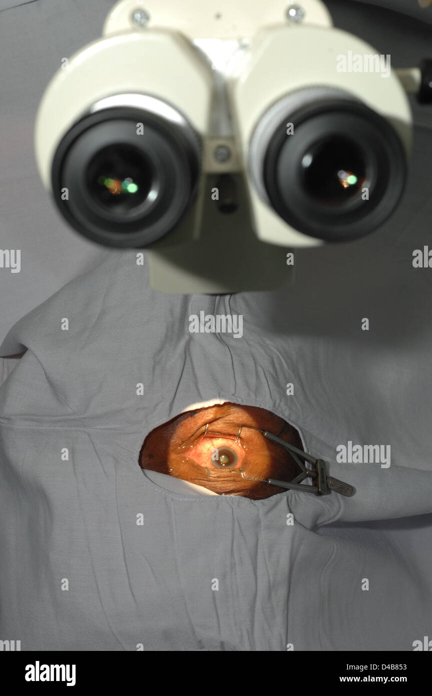 The surgeon's view through the operation. He uses microscope to enhance his vision throughout the procedure. Stock Photo