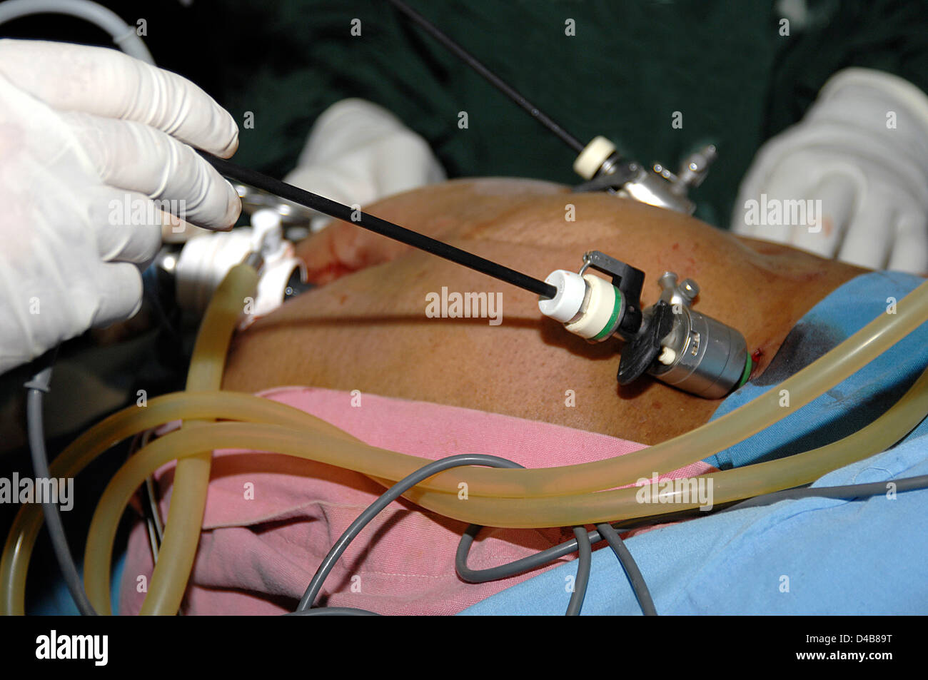 A trocar portal that plugged into abdominal wall enabling surgeon insert remove various laprascopic instruments into different Stock Photo