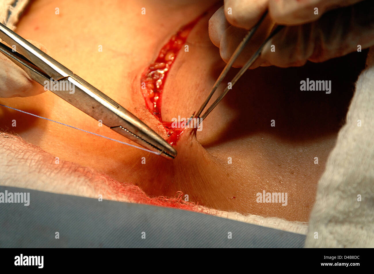 Surgical team stitch wound, after successful removal of goiter, during Thyroidectomy. Sudan, Africa. Stock Photo