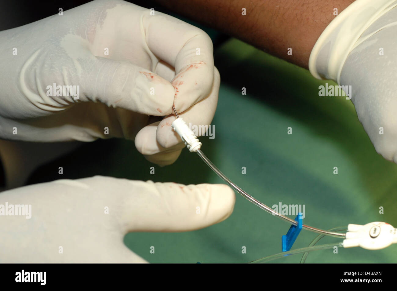 The guide wire fed through one ports on triple lumen catheter. end wire can be seen emerging